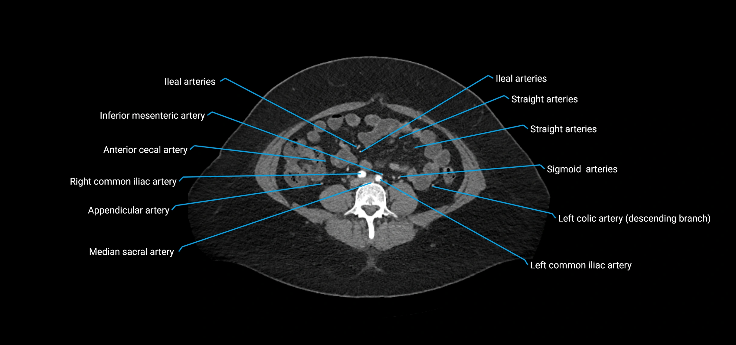 CTA abdomen axial cross sectional anatomy labelled image_141 (2).webp
